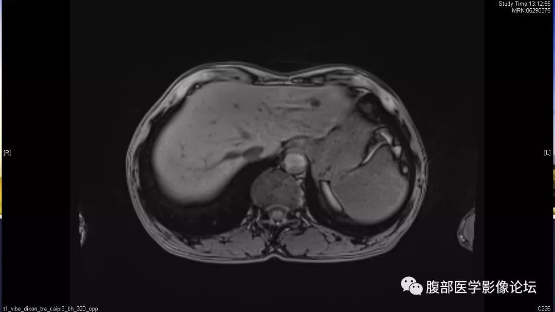 【病例】胰尾局灶性慢性胰腺炎1例MR影像讨论