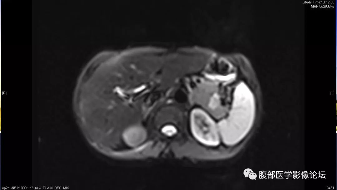 【病例】胰尾局灶性慢性胰腺炎1例MR影像讨论