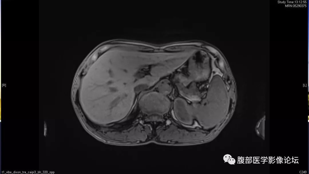 【病例】胰尾局灶性慢性胰腺炎1例MR影像讨论
