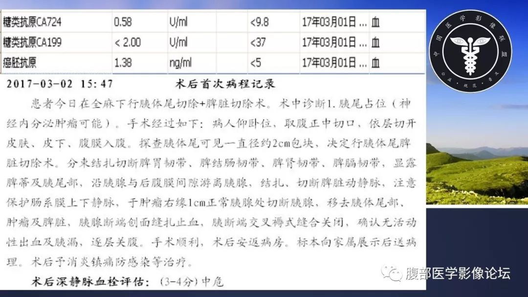 【病例】胰尾局灶性慢性胰腺炎1例MR影像讨论
