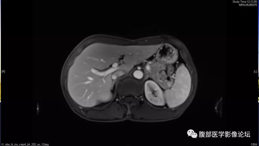 【病例】胰尾局灶性慢性胰腺炎1例MR影像讨论