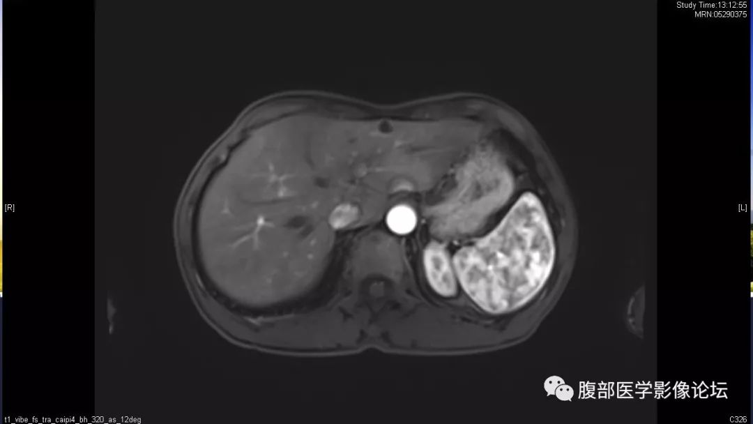 【病例】胰尾局灶性慢性胰腺炎1例MR影像讨论