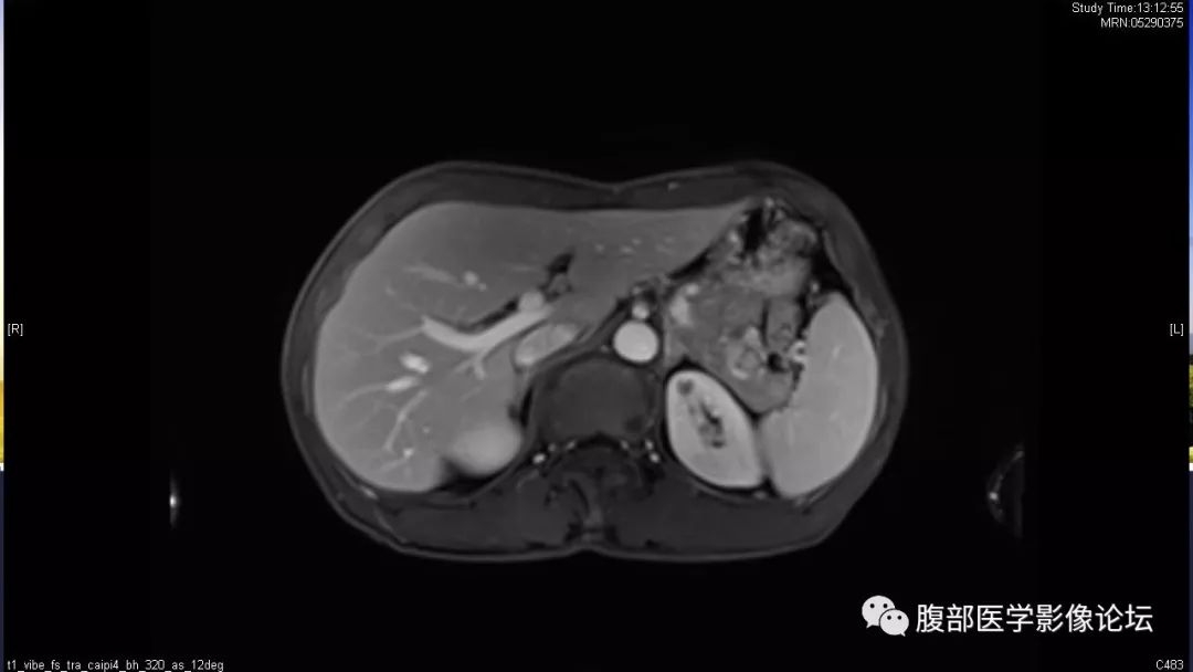 【病例】胰尾局灶性慢性胰腺炎1例MR影像讨论