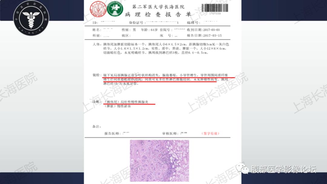 【病例】胰尾局灶性慢性胰腺炎1例MR影像讨论