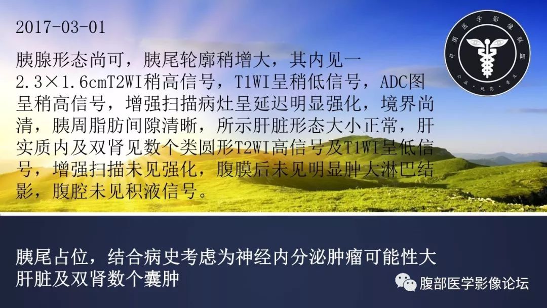 【病例】胰尾局灶性慢性胰腺炎1例MR影像讨论