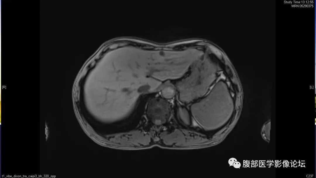 【病例】胰尾局灶性慢性胰腺炎1例MR影像讨论