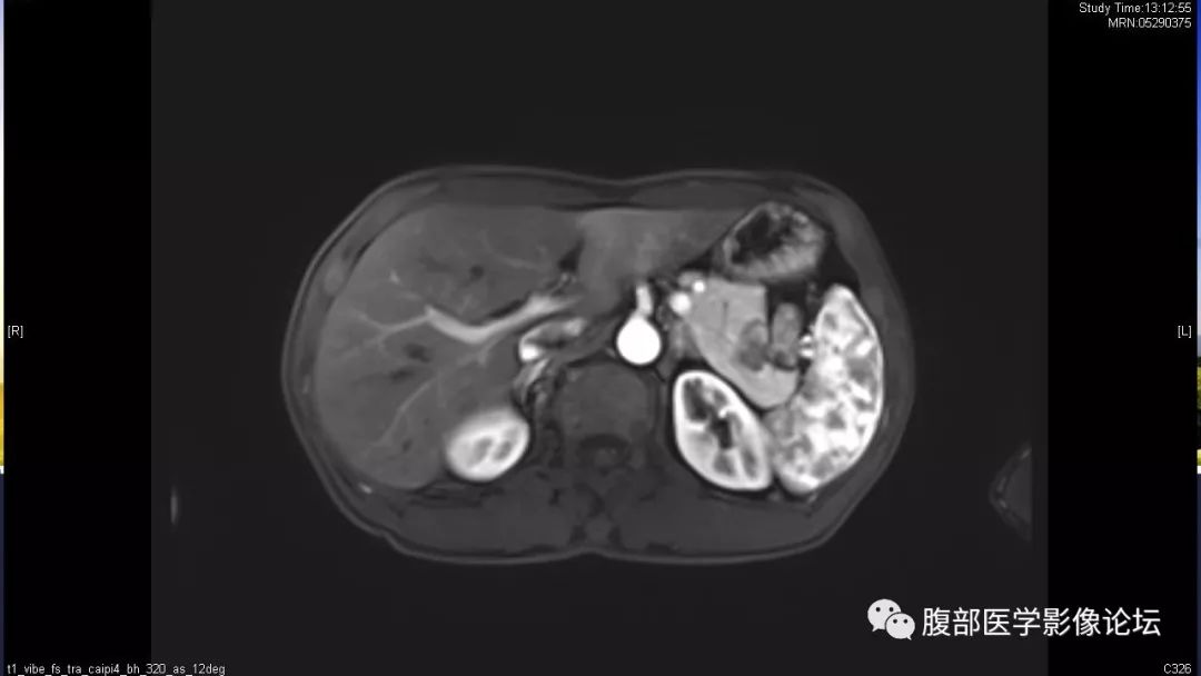 【病例】胰尾局灶性慢性胰腺炎1例MR影像讨论