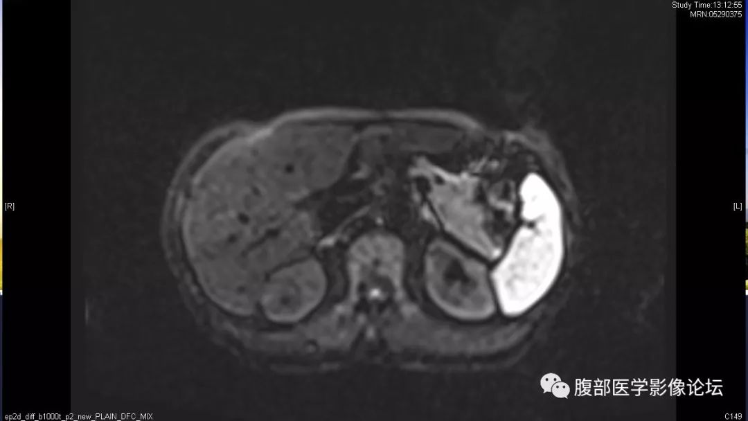 【病例】胰尾局灶性慢性胰腺炎1例MR影像讨论