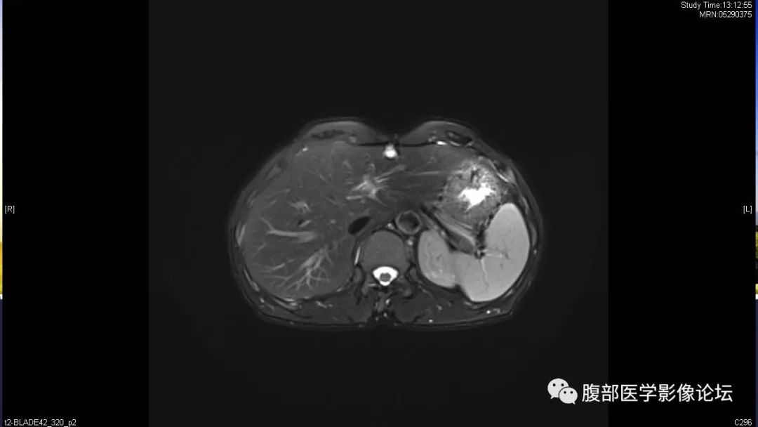 【病例】胰尾局灶性慢性胰腺炎1例MR影像讨论