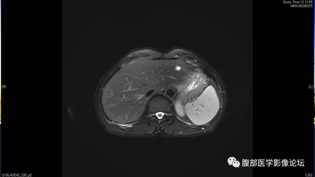 【病例】胰尾局灶性慢性胰腺炎1例MR影像讨论