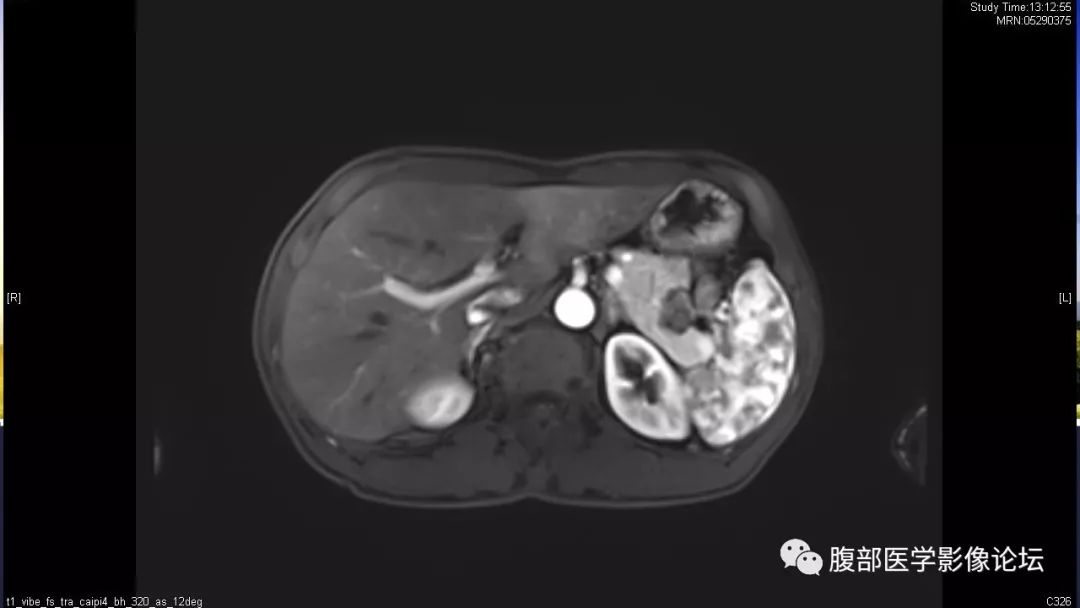 【病例】胰尾局灶性慢性胰腺炎1例MR影像讨论