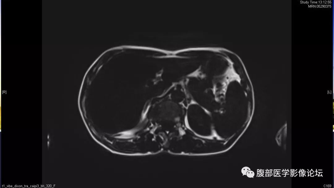 【病例】胰尾局灶性慢性胰腺炎1例MR影像讨论