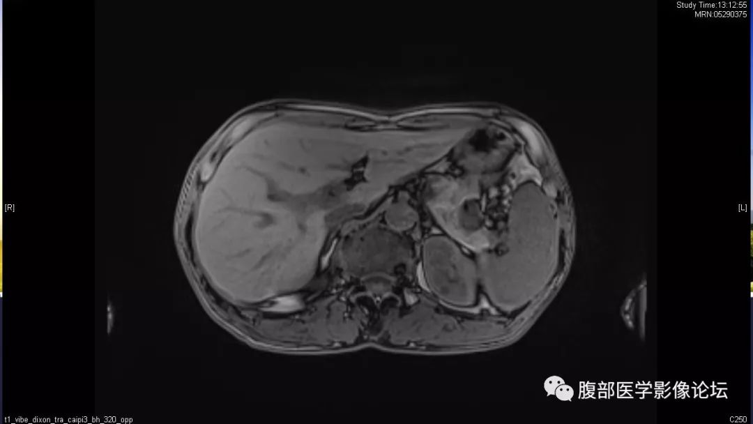 【病例】胰尾局灶性慢性胰腺炎1例MR影像讨论