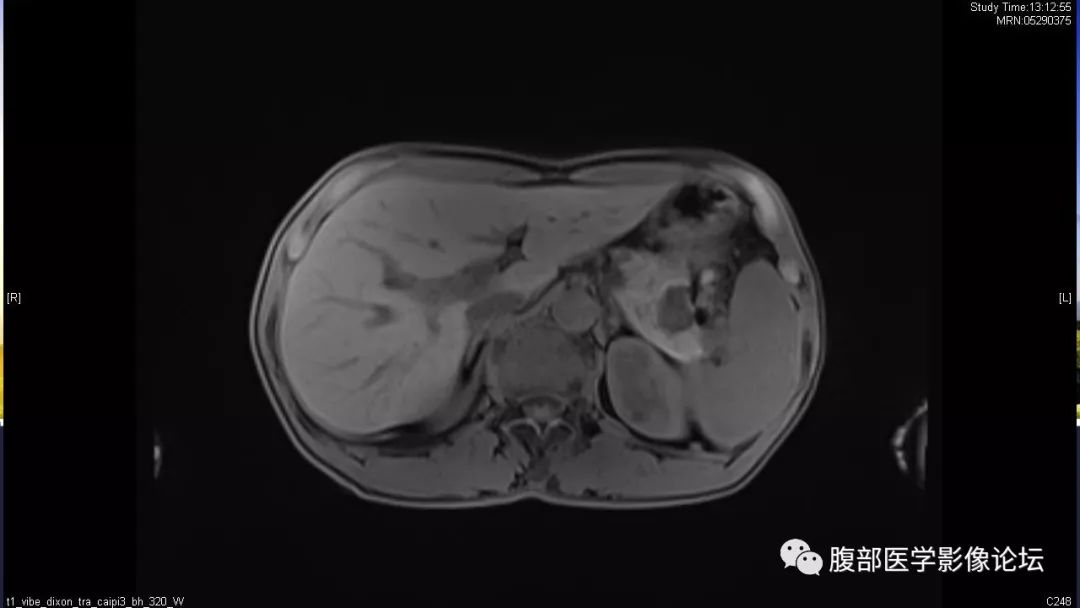 【病例】胰尾局灶性慢性胰腺炎1例MR影像讨论