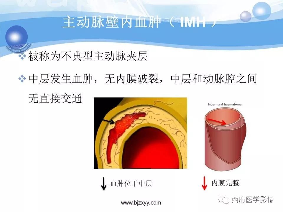 【PPT】主动脉壁间血肿的CT诊断