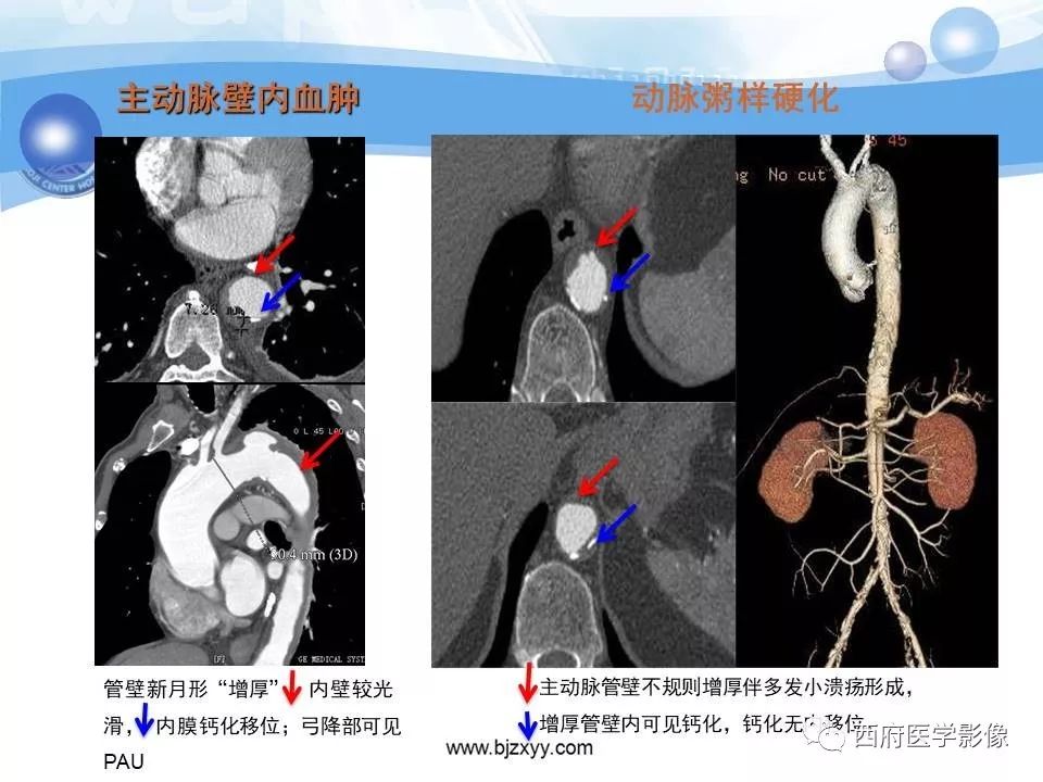 【PPT】主动脉壁间血肿的CT诊断