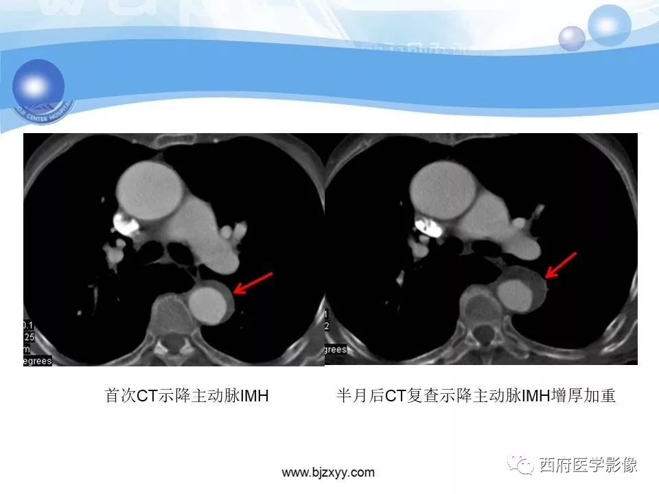 【PPT】主动脉壁间血肿的CT诊断