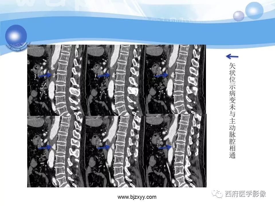 【PPT】主动脉壁间血肿的CT诊断