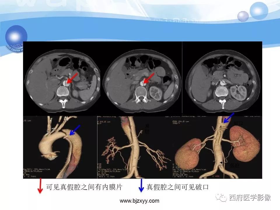 【PPT】主动脉壁间血肿的CT诊断