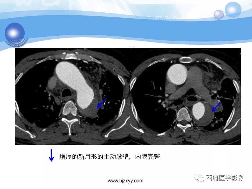 【PPT】主动脉壁间血肿的CT诊断