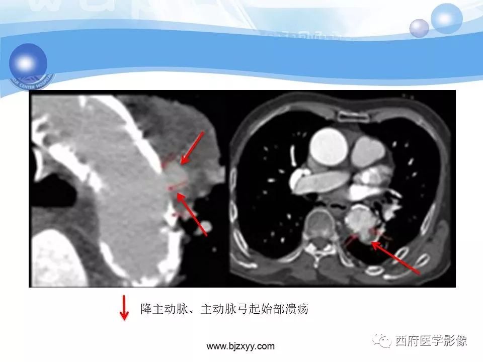 【PPT】主动脉壁间血肿的CT诊断