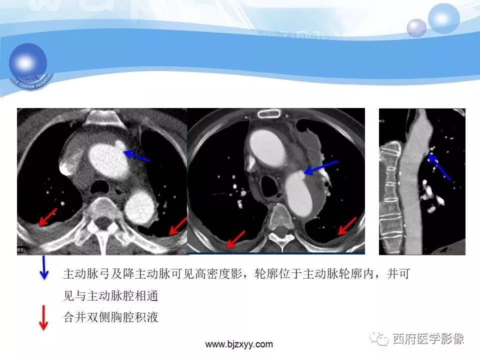 【PPT】主动脉壁间血肿的CT诊断
