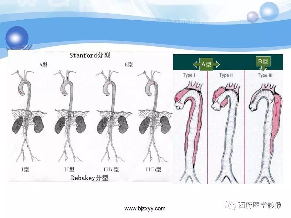 【PPT】主动脉壁间血肿的CT诊断