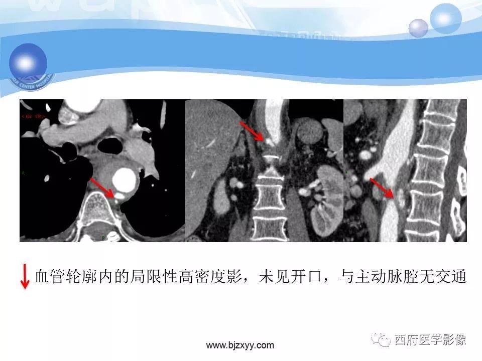 【PPT】主动脉壁间血肿的CT诊断