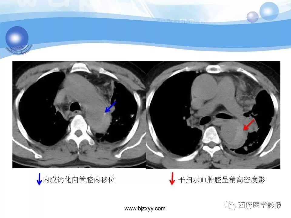 【PPT】主动脉壁间血肿的CT诊断