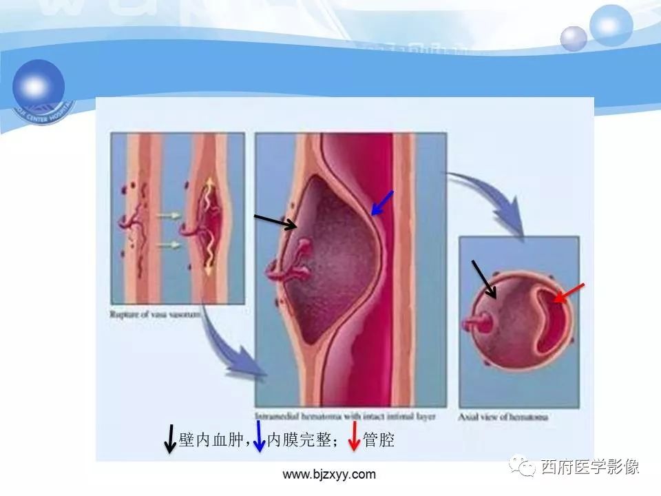 【PPT】主动脉壁间血肿的CT诊断