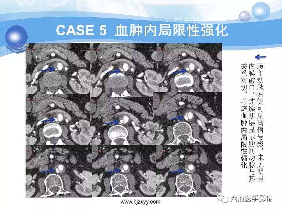 【PPT】主动脉壁间血肿的CT诊断