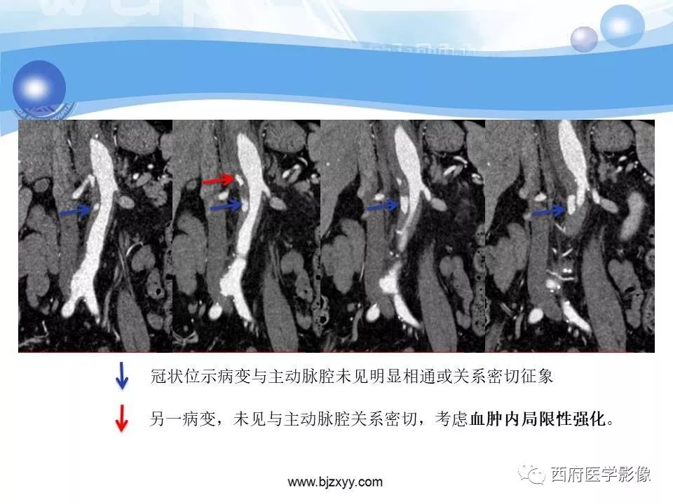 【PPT】主动脉壁间血肿的CT诊断
