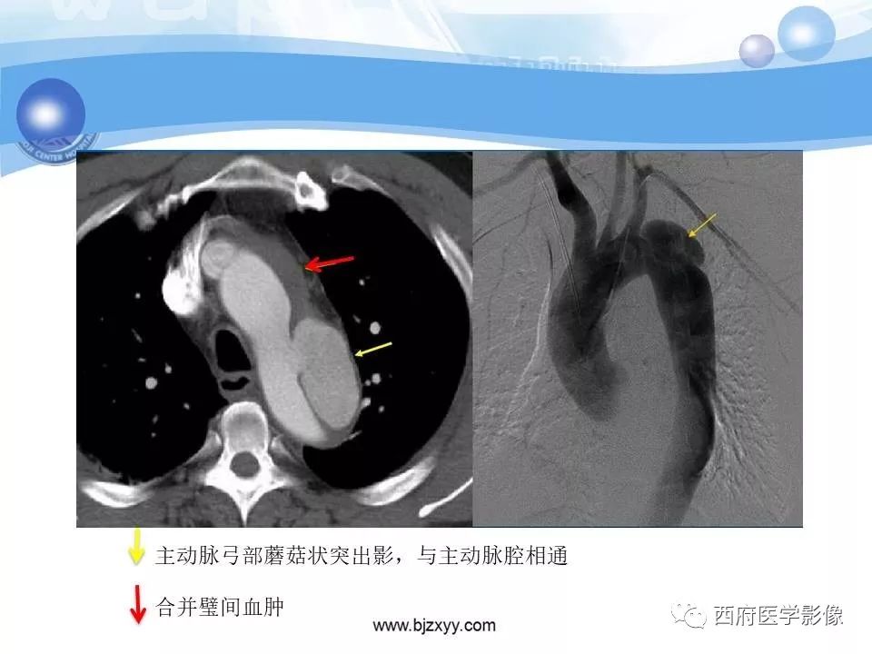 【PPT】主动脉壁间血肿的CT诊断
