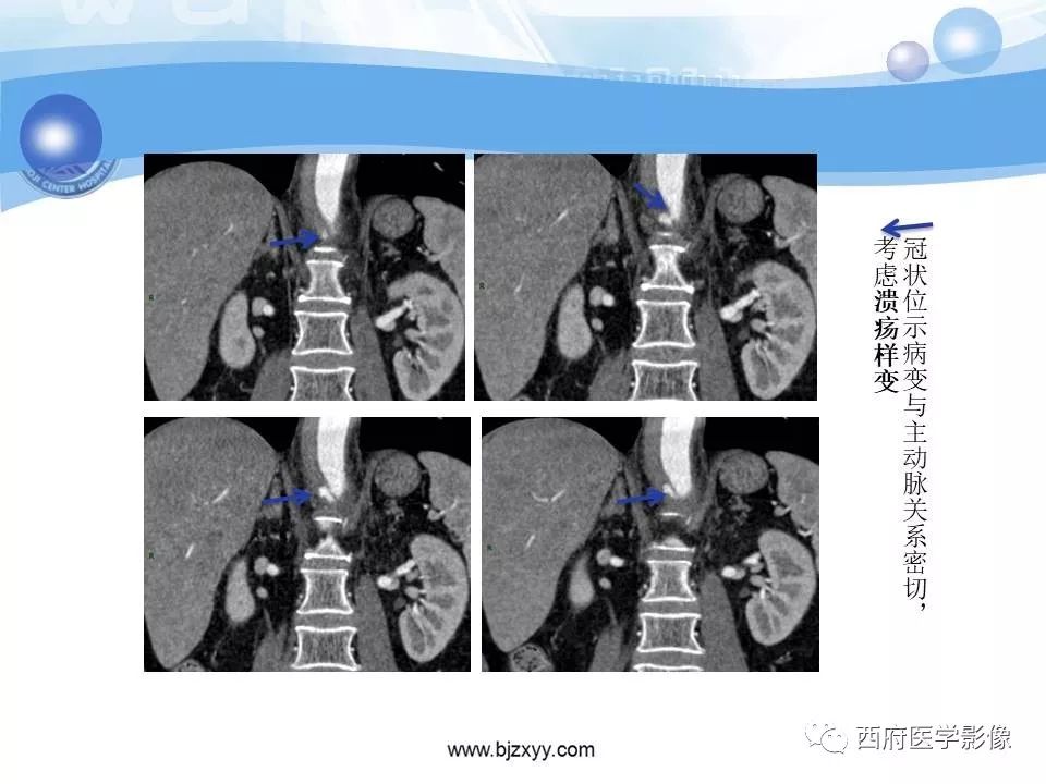 【PPT】主动脉壁间血肿的CT诊断