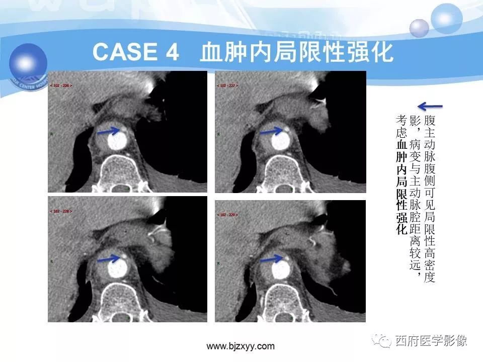 【PPT】主动脉壁间血肿的CT诊断