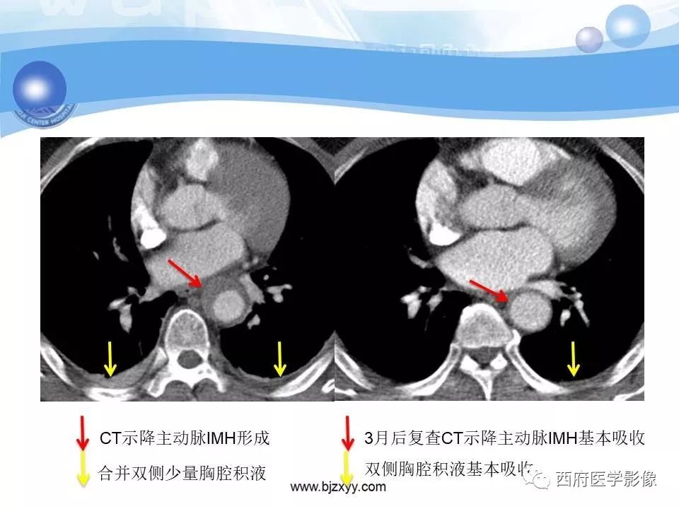 【PPT】主动脉壁间血肿的CT诊断