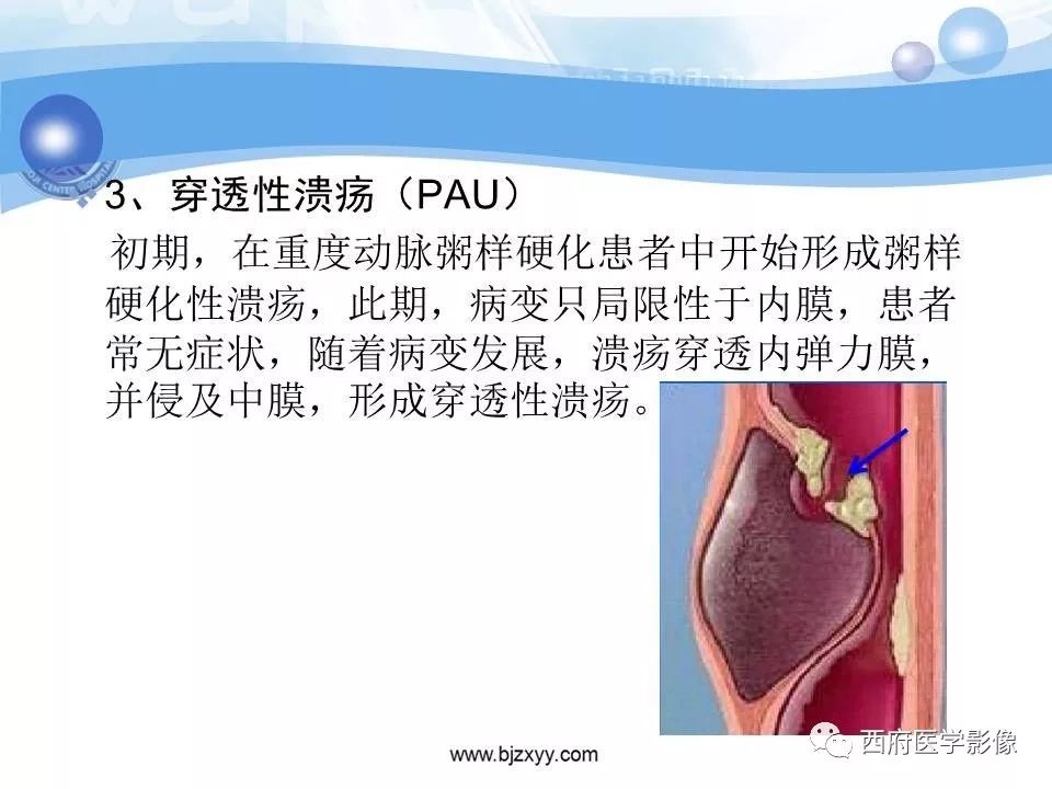 【PPT】主动脉壁间血肿的CT诊断