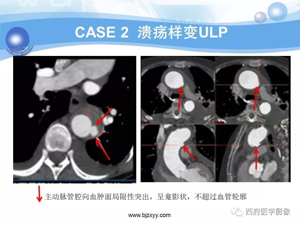 【PPT】主动脉壁间血肿的CT诊断