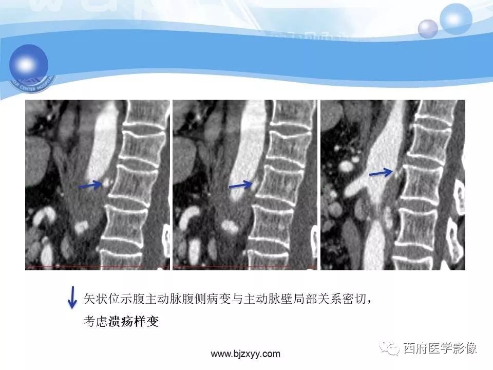 【PPT】主动脉壁间血肿的CT诊断