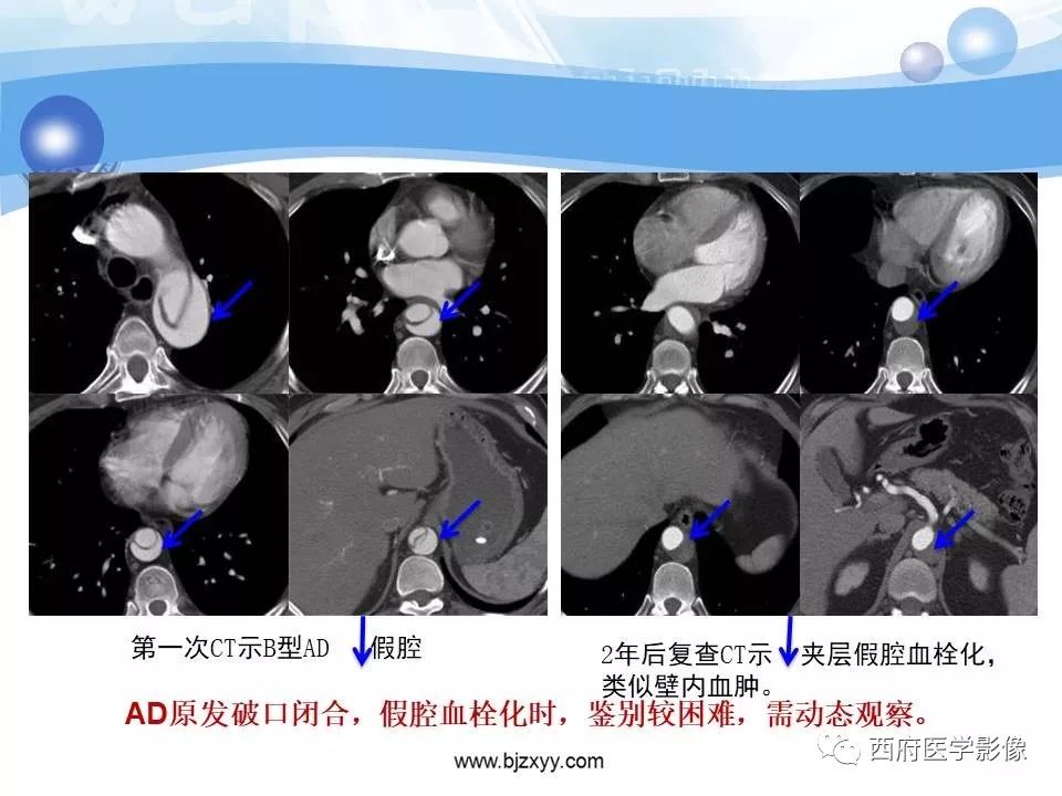 【PPT】主动脉壁间血肿的CT诊断