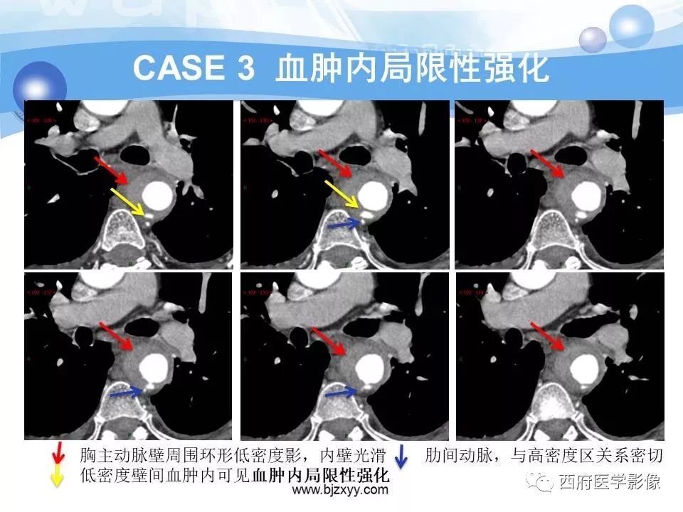 【PPT】主动脉壁间血肿的CT诊断