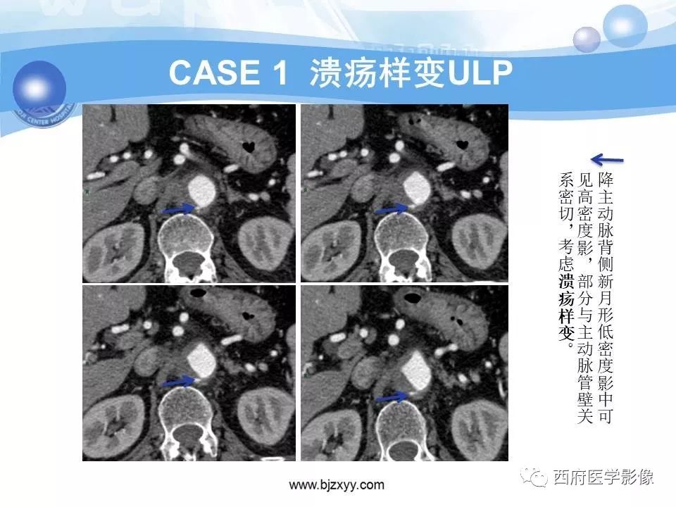 【PPT】主动脉壁间血肿的CT诊断