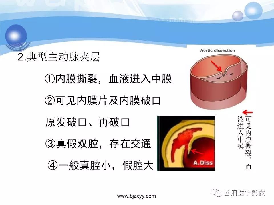 【PPT】主动脉壁间血肿的CT诊断