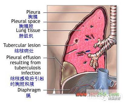 详解胸腔积液形成机理及各类影像表现