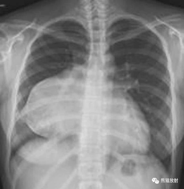 详解胸腔积液形成机理及各类影像表现