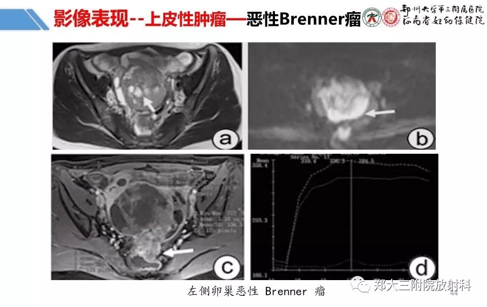 【PPT】卵巢肿瘤的影像诊断思路 【PPT】卵巢肿瘤的影像诊断思路