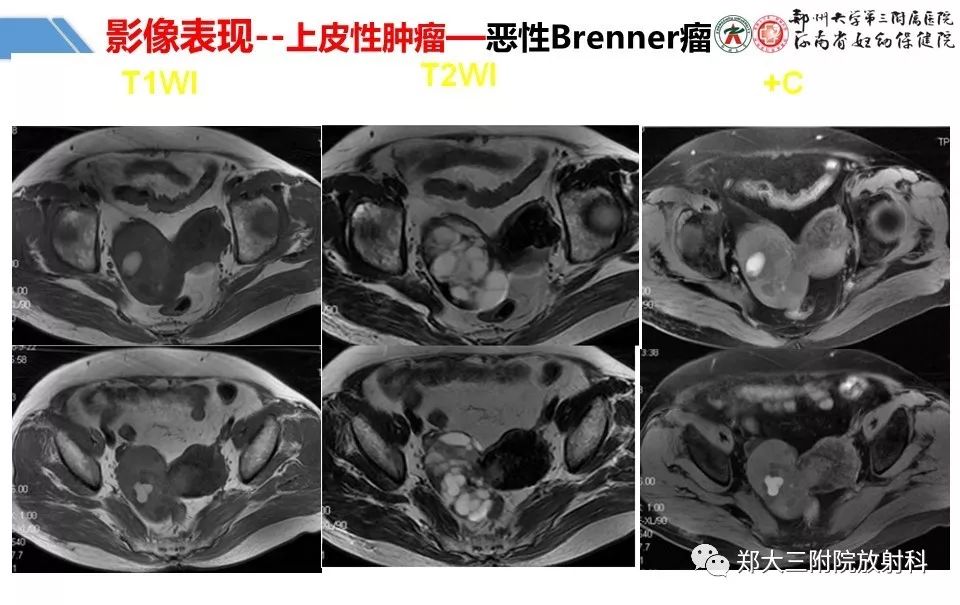 【PPT】卵巢肿瘤的影像诊断思路 【PPT】卵巢肿瘤的影像诊断思路