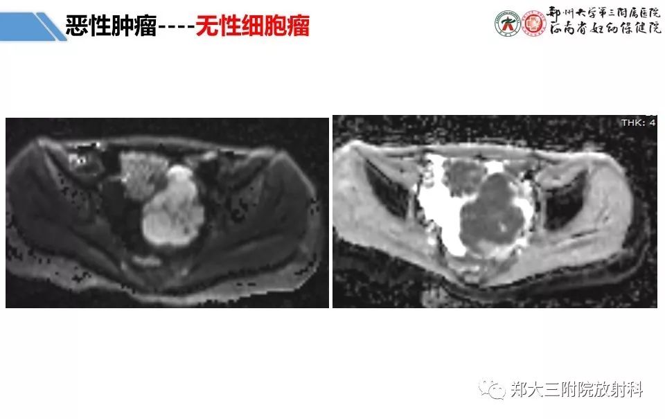 【PPT】卵巢肿瘤的影像诊断思路 【PPT】卵巢肿瘤的影像诊断思路