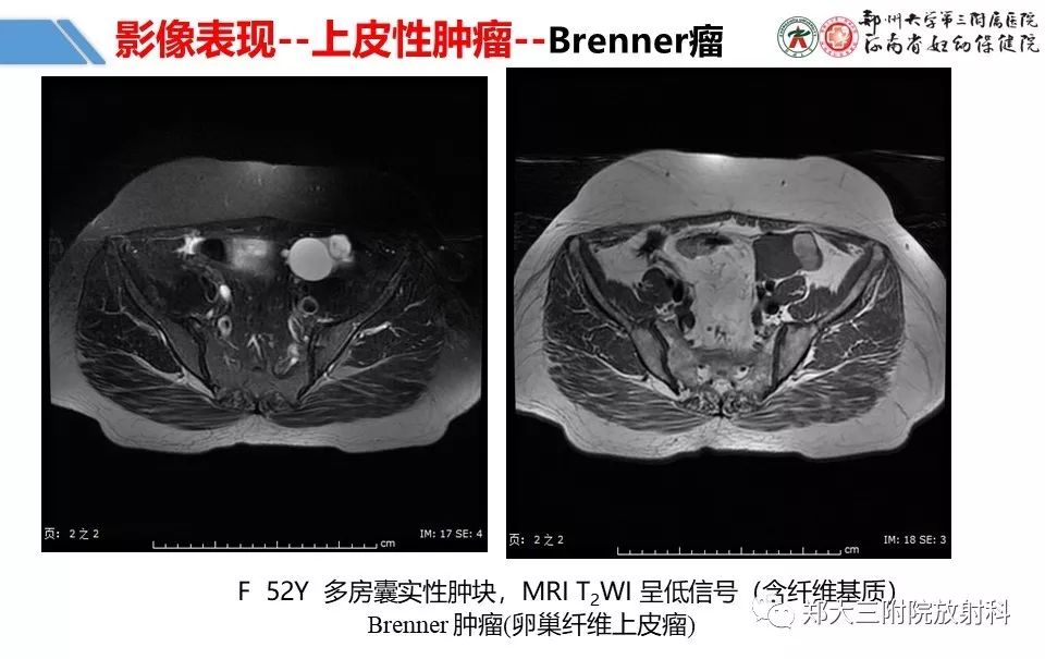 【PPT】卵巢肿瘤的影像诊断思路 【PPT】卵巢肿瘤的影像诊断思路