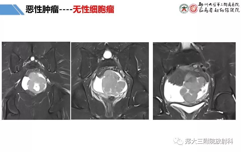 【PPT】卵巢肿瘤的影像诊断思路 【PPT】卵巢肿瘤的影像诊断思路